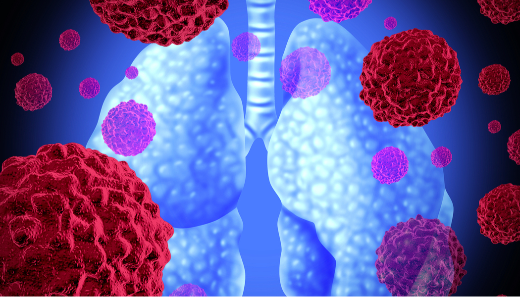 Non-Small Cell Lung Cancer Treatment Market Is Estimated To Witness High Growth Owing To Increasing Incidence of Lung Cancer