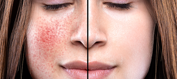 Global Rosacea Treatment Market Is Estimated To Witness High Growth Owing To Increasing Prevalence of Rosacea