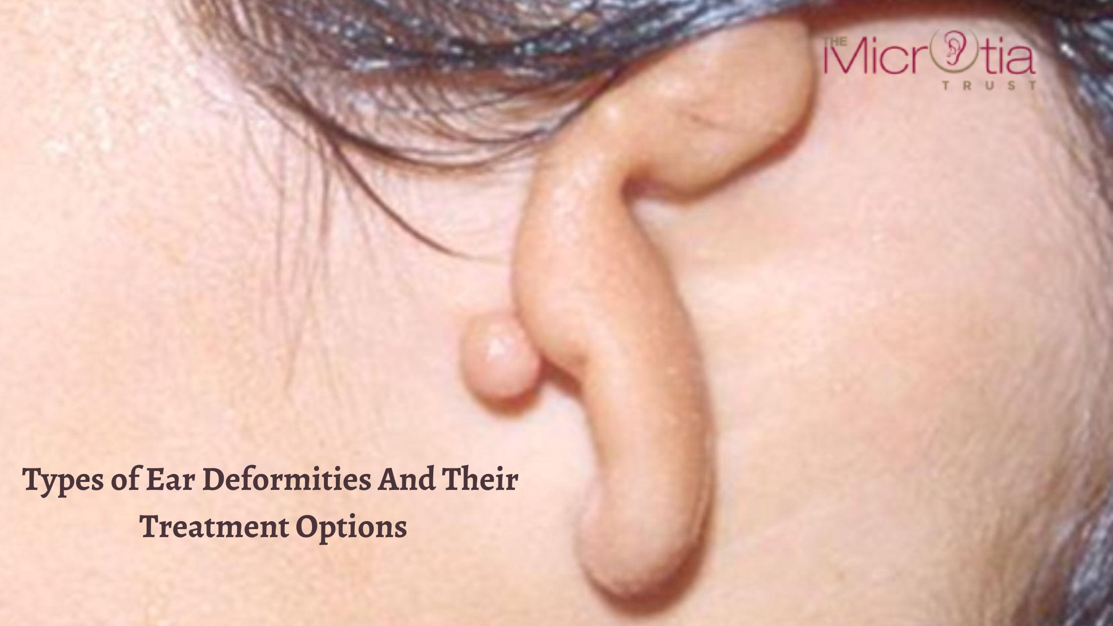 Types of Ear Deformities And Their Treatment Options