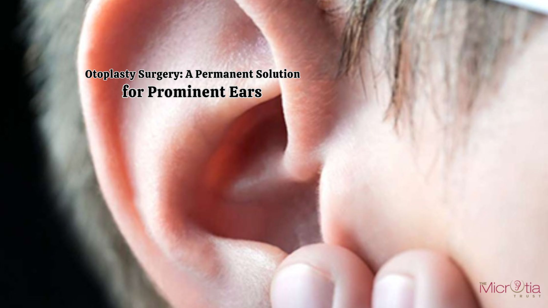Otoplasty Surgery: A Permanent Solution for Prominent Ears