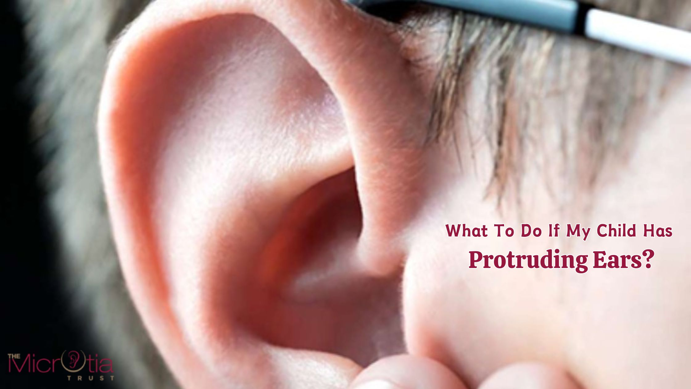 What To Do If My Child Has Protruding Ears?