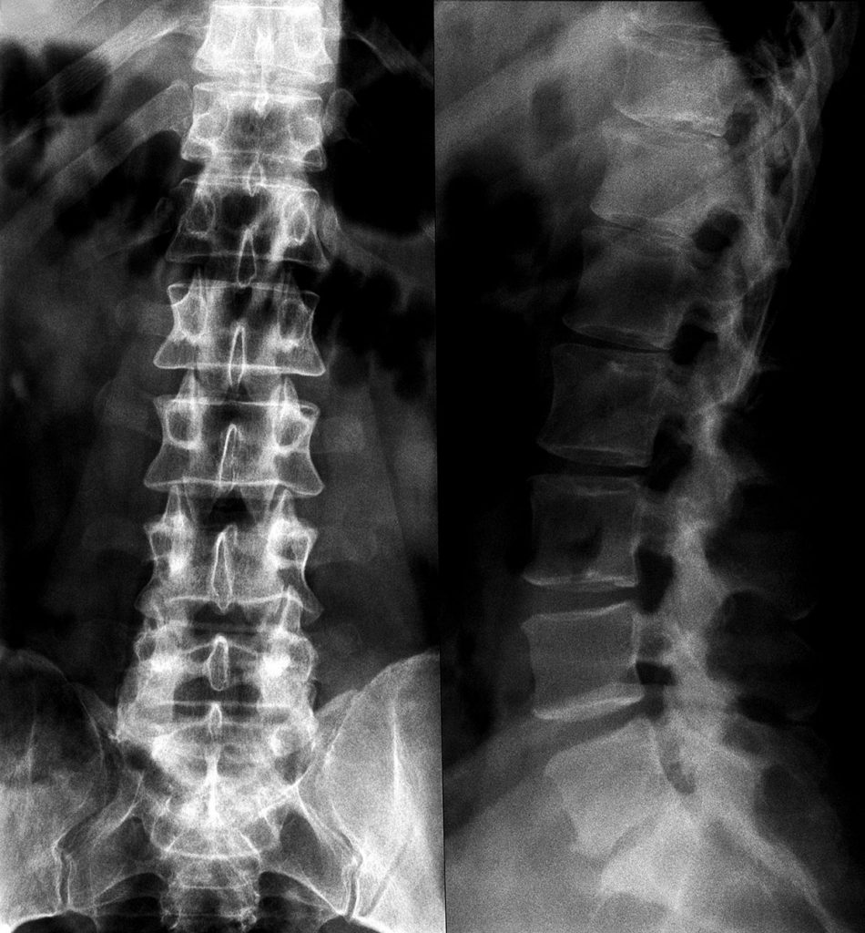 خشونة فقرات العمود الفقرى