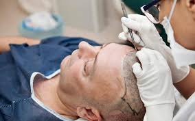 Top 3 Benefits of Hair Transplant Surgery 