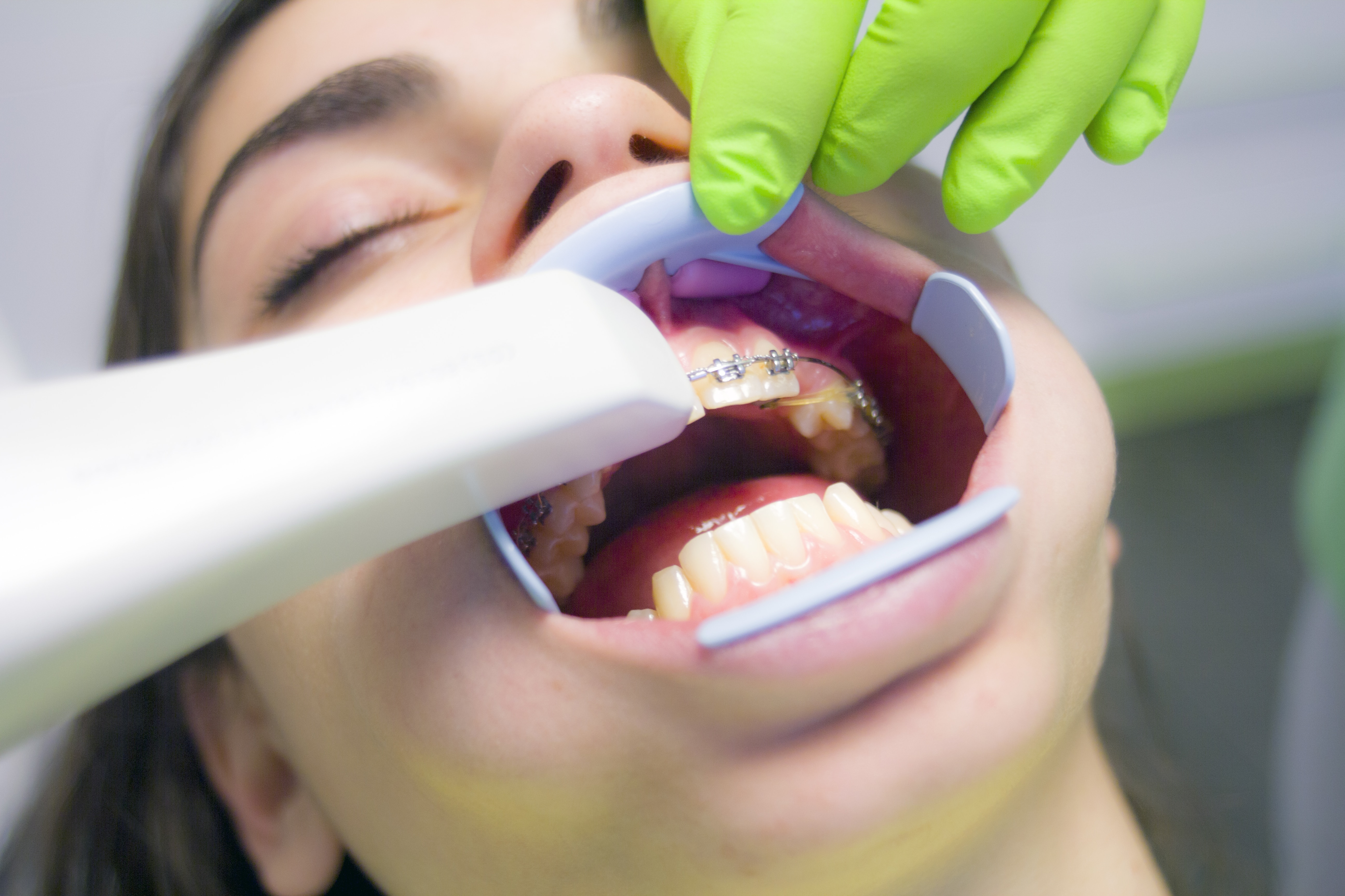 Straighten Your Smile with Clear Aligners: A Modern Solution to Crooked Teeth