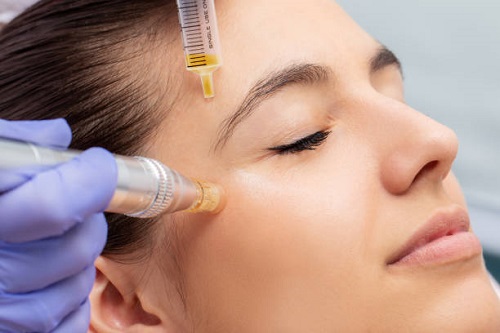 RF Microneedling Market Latest Innovations, Drivers and Industry Status 2022- 2027