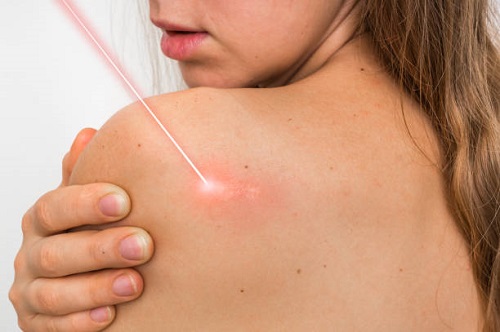 Keloid Treatment Market by revenue is expected to grow at a CAGR of 3.5% during the period 2018–2023