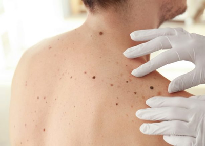 Melanoma Skin Cancer – 5 Surprising Facts