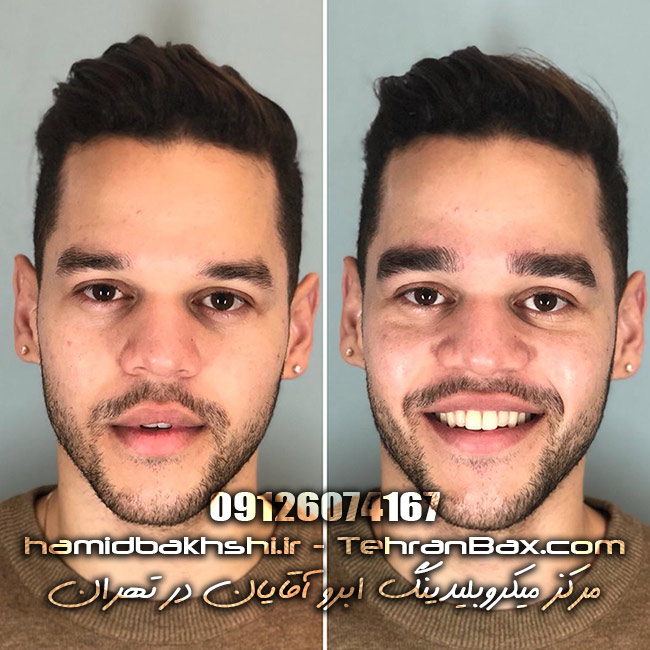 میکروبلیدینگ ابرو آقایان در تهران 