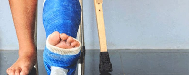Tips for Faster Recovery from Fractures