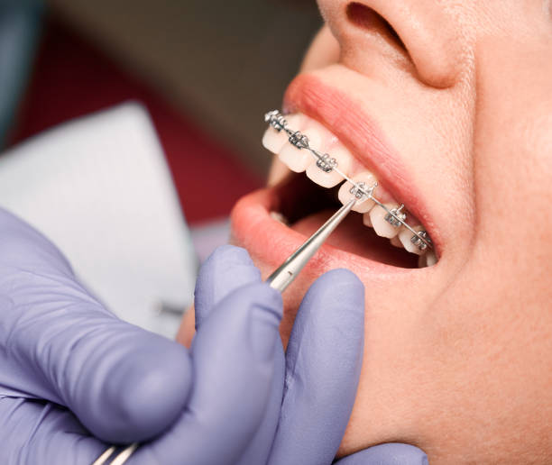 Factors that Prioritize the Orthodontist for Braces Care