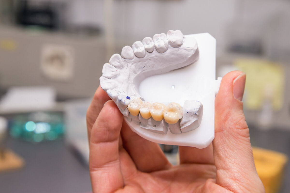 4 Dental Bridges and Why You Must Get Them