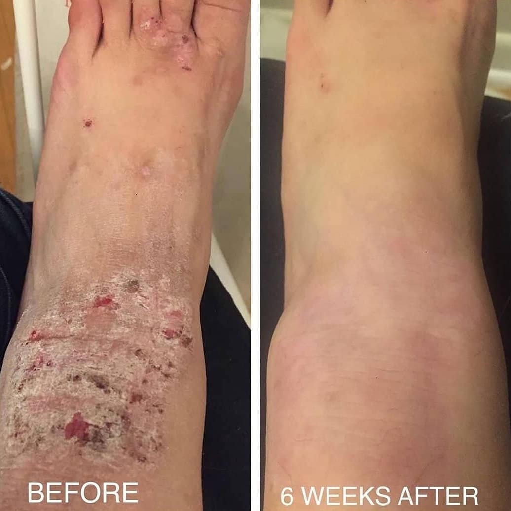 What’s The Difference Between Psoriasis & Eczema?