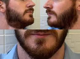 Beard Transplant Market 2022 Size, Dynamics & Forecast Report to 2028