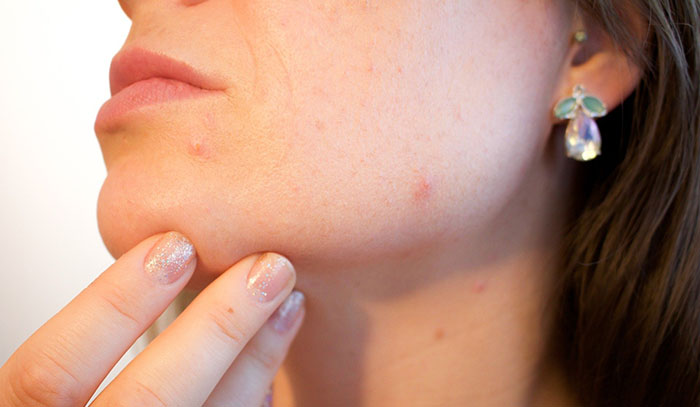 Best Acne treatment and causes in delhi