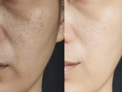 Understanding Skin Rejuvenation Procedures