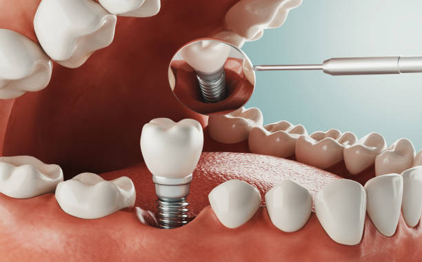 Enhance Your Smile Permanently: Dental Implants from a Park Ridge Family Dentist