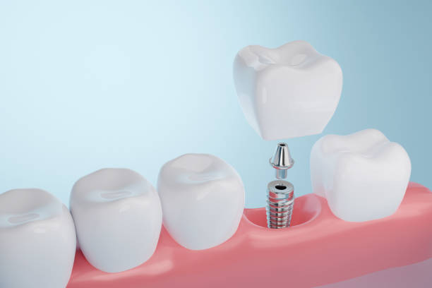 How Dental Implants Can Restore Your Smile and Confidence