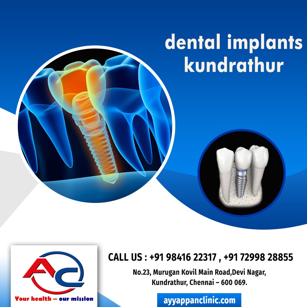 Dental Implants in Kundrathur — Do You Know Why Are They Important?