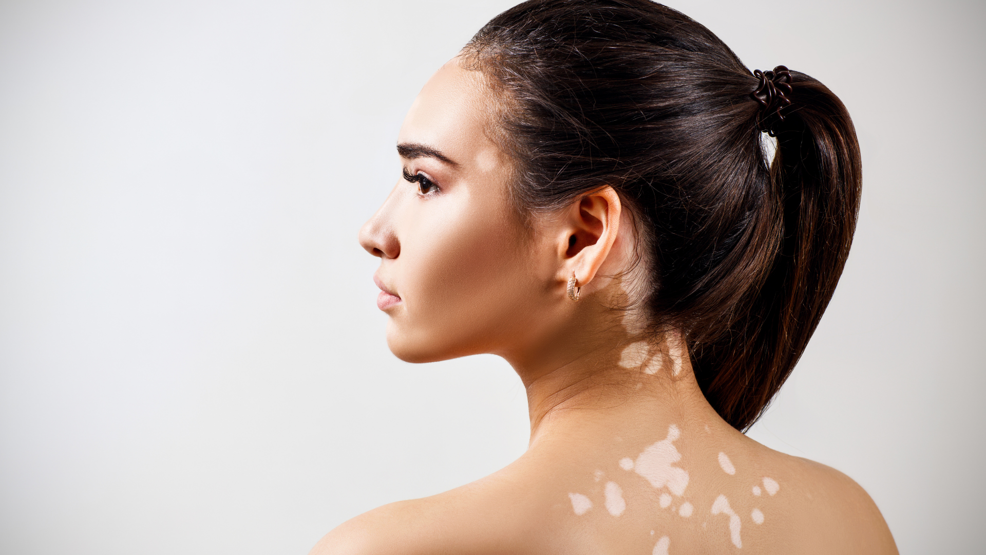 Vitiligo Treatment: How to Get Rid of It