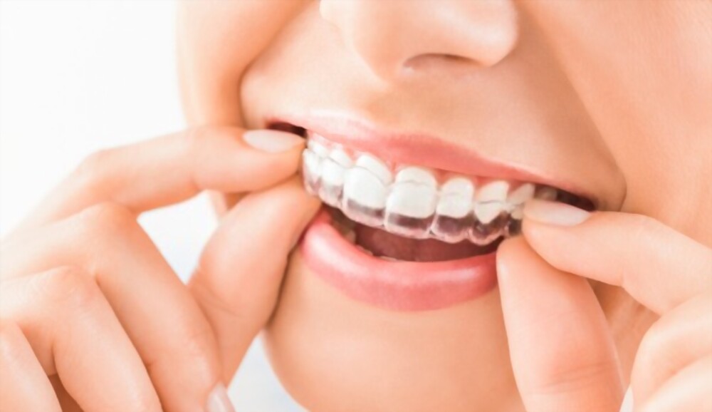 How much does Invisalign in Melbourne Costs?