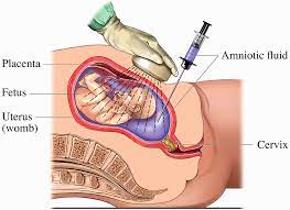 Turner Syndrome Treatment Market | Global Industry Trends, Segmentation, Business Opportunities & Forecast To 2028