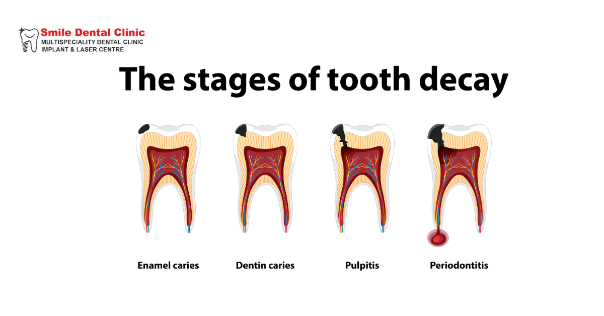 Signs You Might Need a Root Canal Treatment