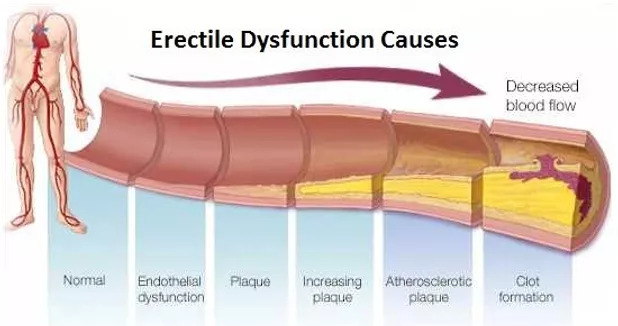 Erectile Dysfunction Treatment In Kuala Lumpur – Treat Lack Of Sexual Desire