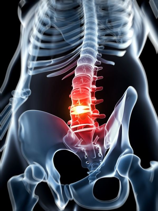 Understanding Herniated Disks: Symptoms, Causes, and Treatment Options