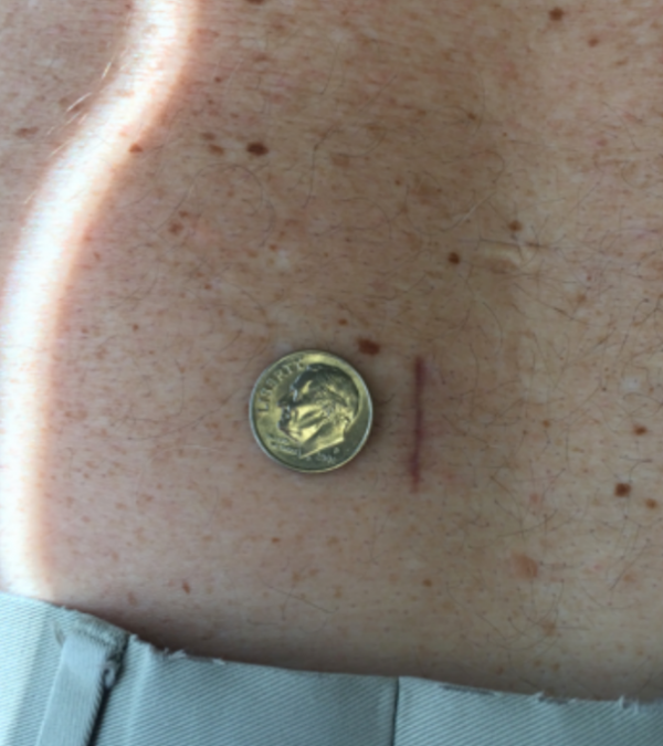 The Advantages of Minimally Invasive Spine Surgery in Florida