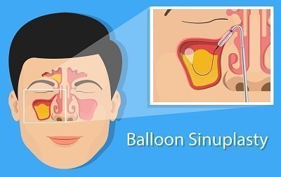 Combatting Chronic Sinusitis in Fort Myers with Balloon Sinuplasty 