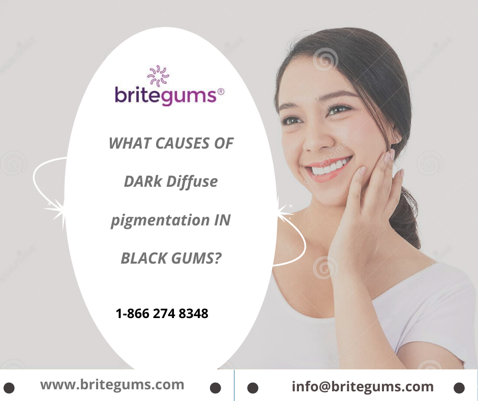 WHAT CAUSES OF DARk Diffuse pigmentation IN BLACK GUMS?