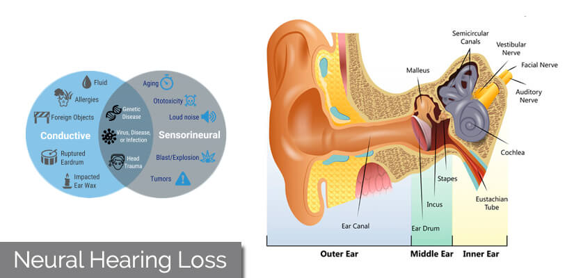 What is Neural Hearing Loss?