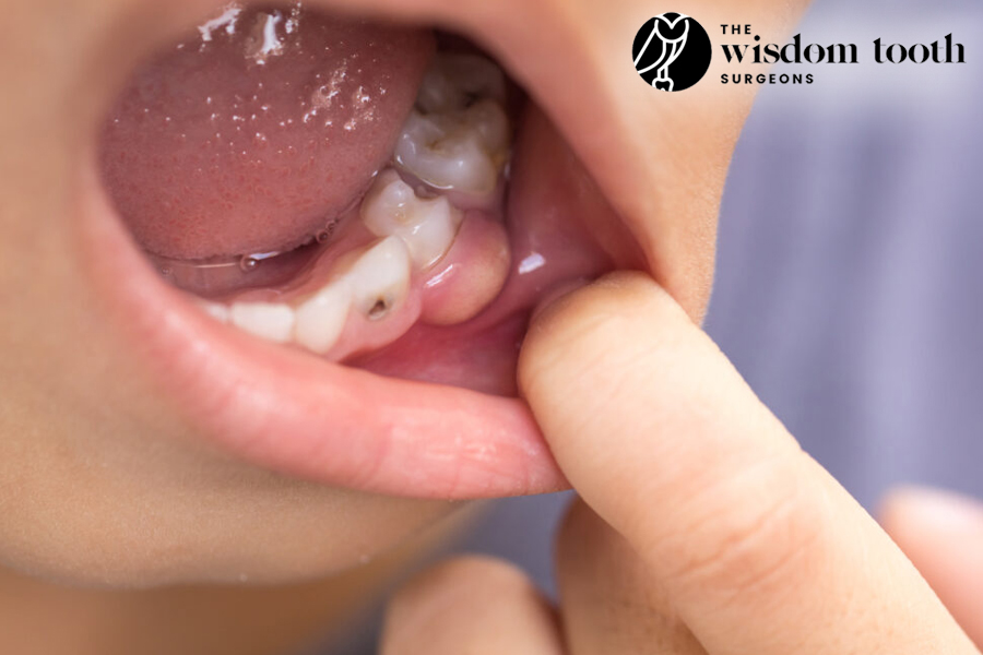 How to Get Ready for Wisdom Tooth Extraction?