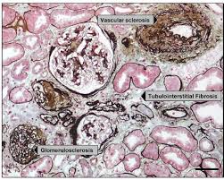 Kidney/Renal Fibrosis Treatment Market | Industry Trends, Segmentation, Opportunities Analysis and Forecast To 2028