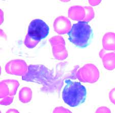 Global T-Cell Acute Lymphoblastic Leukemia Market 2022 - Top Manufacturers Analysis Report Till 2028