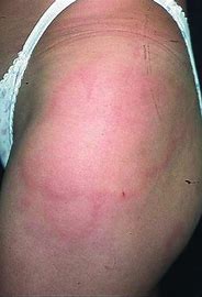 Leprosy Treatment Market 2022 Industry Report by Key Players, Industry Outlook and Opportunity Analysis till 2028