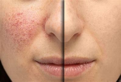 Rosacea Treatment Market 2022 Global Impact of COVID-19 on Industry, Share, Growth, Trends, Analysis by Top Key Player and Forecast till 2028 
