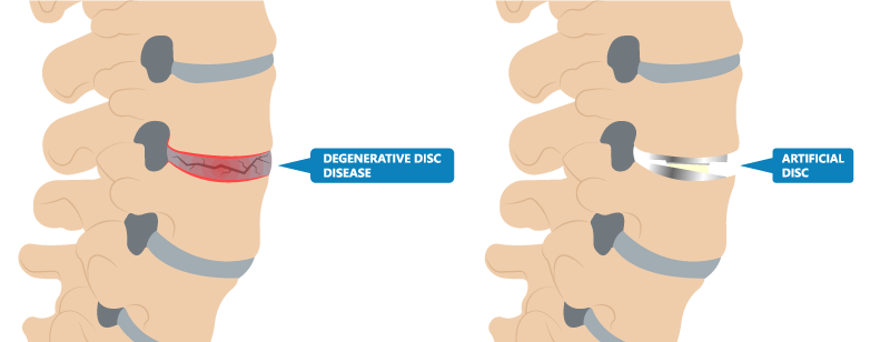Replacement of Artificial Discs for Neck and Spine Injuries