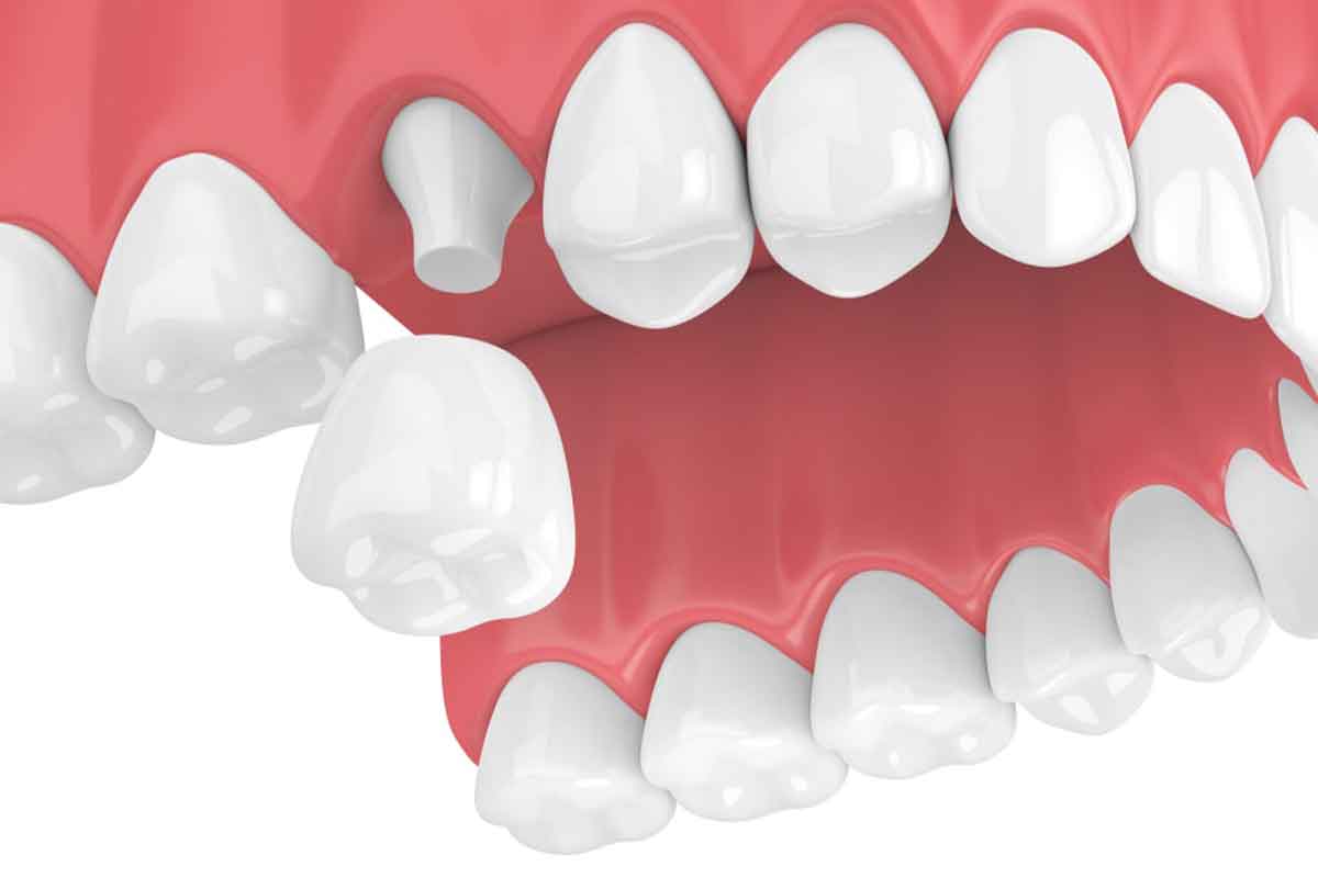 Pediatric Dental Crown Market Report 2022 : By Type, Product, Top-Companies And Forecast Till 2031