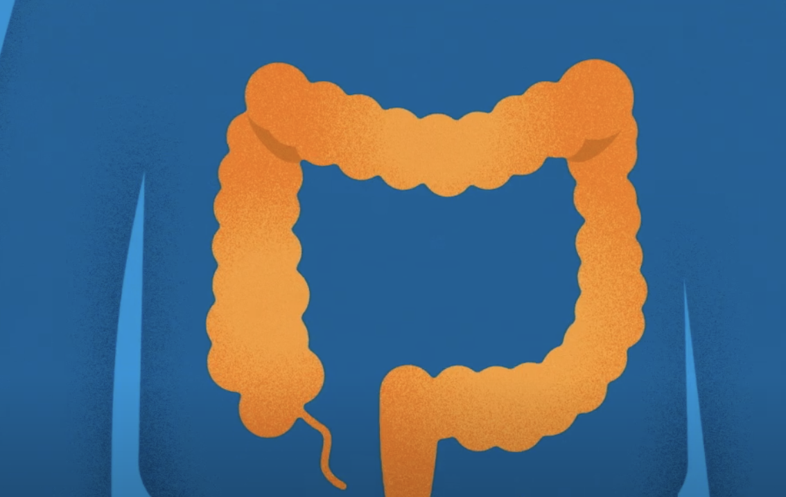 How to Prepare for a Colonoscopy