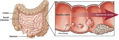 Happy Colorectal Cancer Awareness Month!