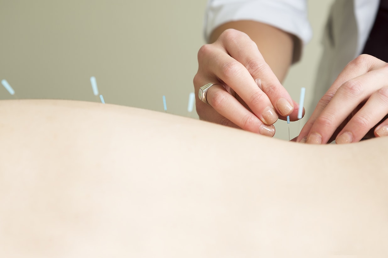 Why Acupuncture Is Beneficial For Treating Anxiety?