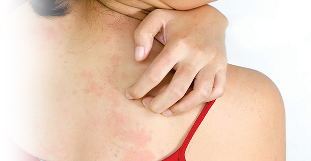 How Traditional Chinese Medicine Can Provide You Relief from Eczema