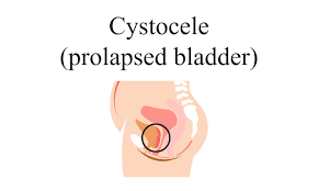 Bladder Prolapse (Cystocele) Market Size, Status, Growth | Industry Analysis Report 2022-2028