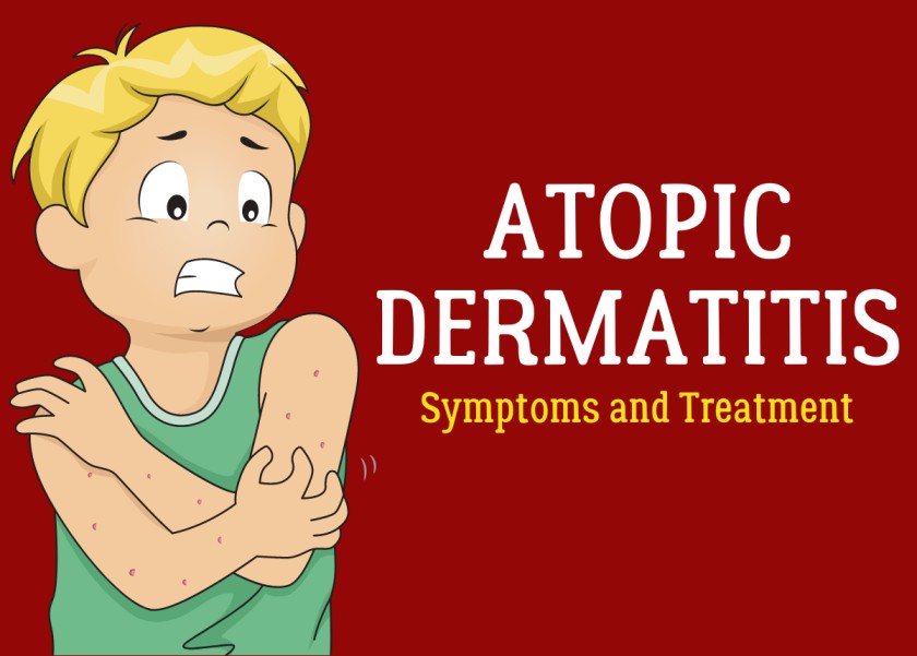 Atopic Dermatitis Treatment Market Size, Status, Growth | Industry Analysis Report 2022-2028