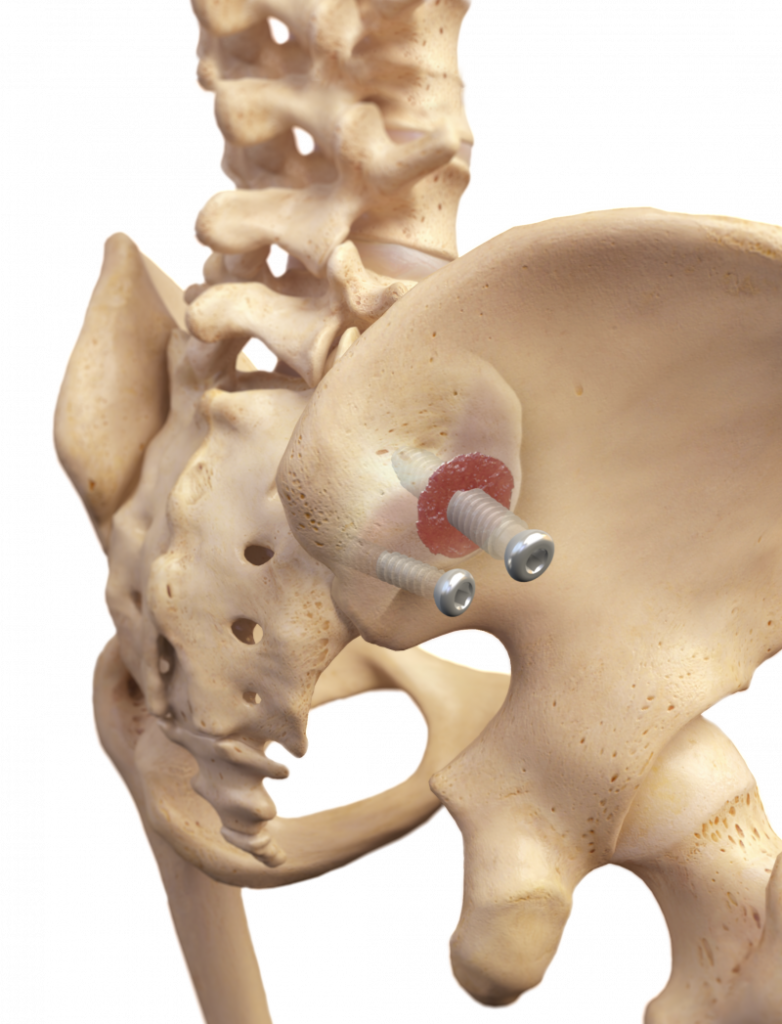 Sacroiliac Joint Fusion Market 2022 | Industry Demand, Fastest Growth, Opportunities Analysis and Forecast To 2028