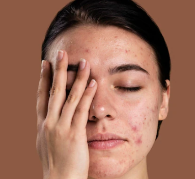 WHAT CAUSES ACNE SCARS?	