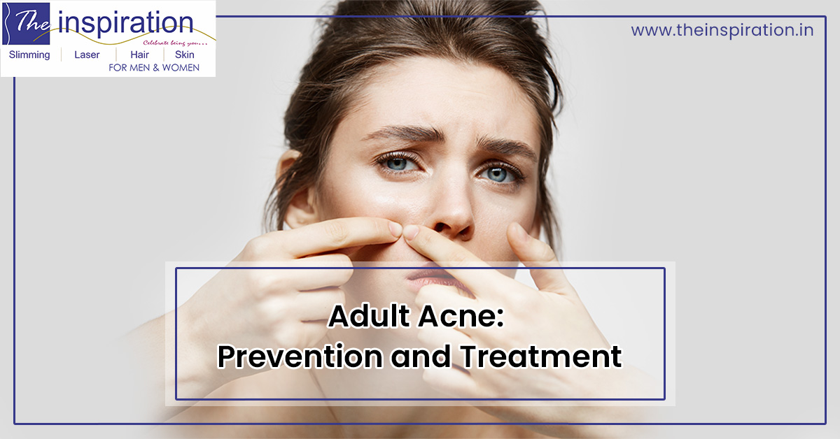 Adult Acne: Prevention and Treatment