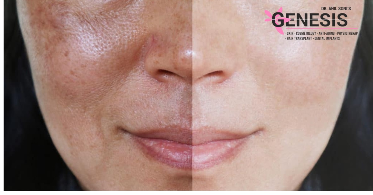 Clear skin ahead: effective treatments for melasma