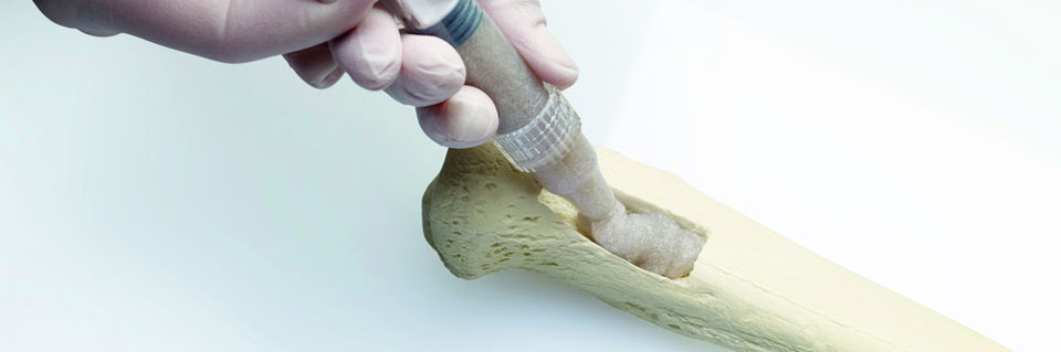 Bone Grafts and Substitutes Market Information, Figures, and Analytical Insights 2022– 2030